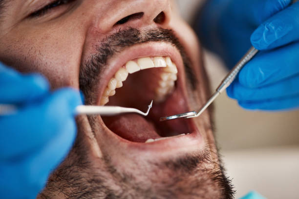 Best Emergency Tooth Extraction in Centerville, SC
